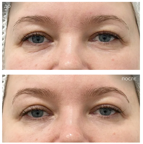 Гель-пилинг для кожи вокруг глаз ARGININE-LACTIC GEL-PEEL, 30 мл фото 2