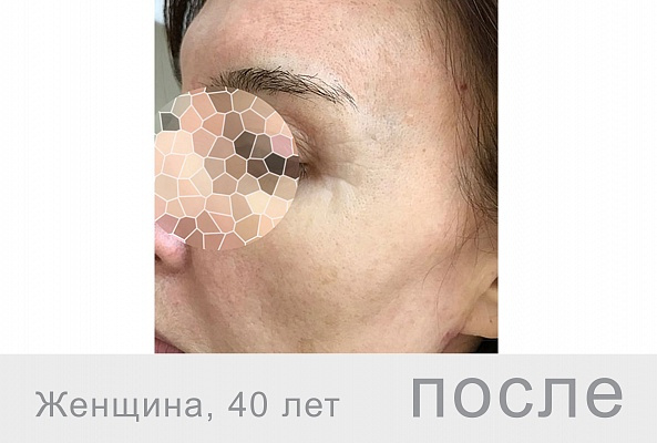 BEAUTELLE 40+ (шприц 2мл) фото 4