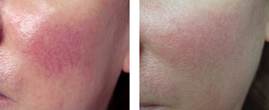  Лазерная платформа DIO LIGHT (diode + ipl) фото 6