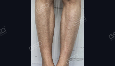 Диодный лазер COOLITE BOLT 1800W фото 9